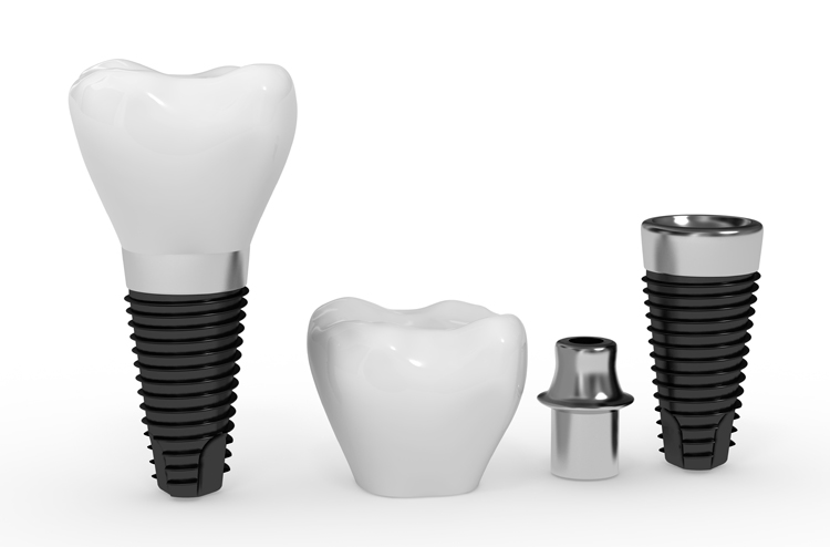 implants-dentaires-couture-duhamel-dentiste
